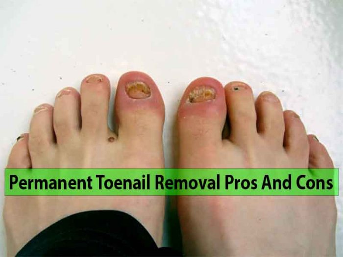 Permanent toenail removal pros and cons