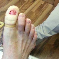 Ingrown toenails toenail surgical skin rid