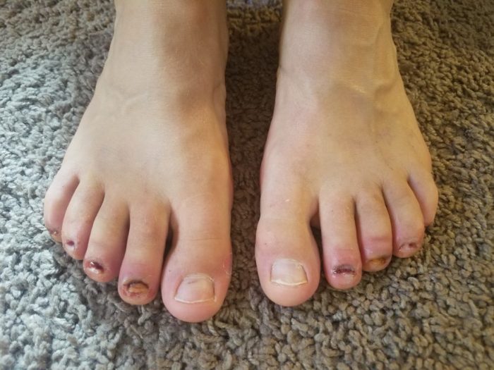 Permanent toenail removal pros and cons